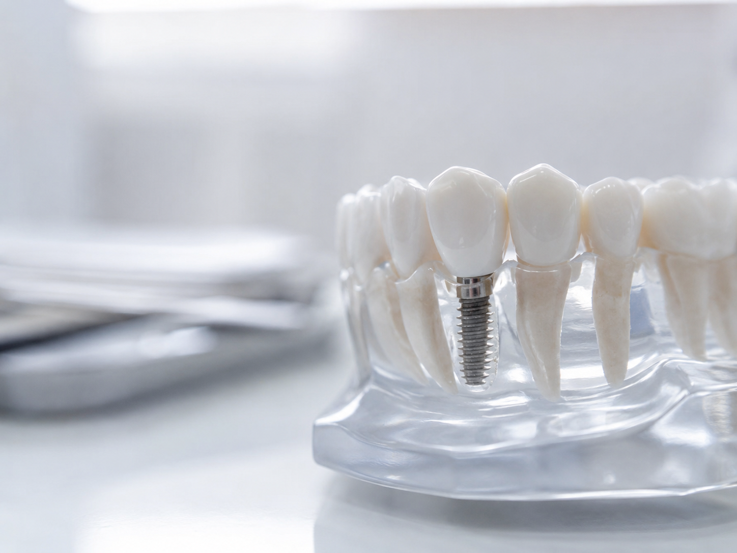 Ilustração editorial de implante dentário